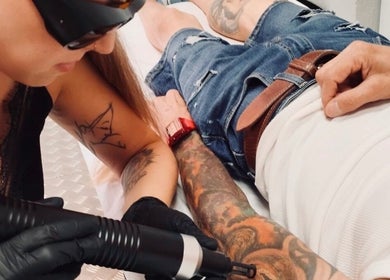 Procedimiento de eliminación de tatuajes en Skin Láser, Daganzo De Arriba, Comunidad De Madrid, ES.
