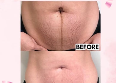 Hasil sebelum dan sesudah perawatan kulit di Pearl Beauty Studio, Nusa Tenggara Timur. Kesan mengesankan.