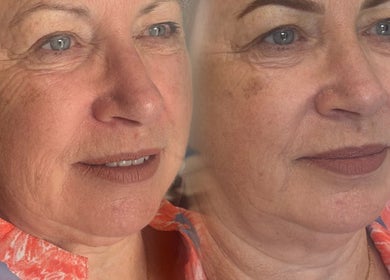 Before and after beauty treatment at Forever Grace Cosmetic Studio, Pegasus, Canterbury Region, NZ.
