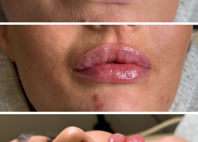 Close-up of lip enhancement treatment at Kr house of aesthetics, Dundee, Scotland, GB.