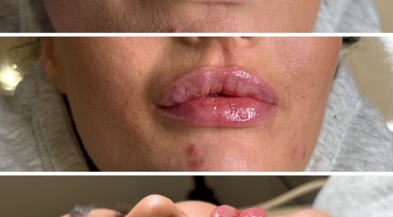 Close-up of lip enhancement treatment at Kr house of aesthetics, Dundee, Scotland, GB.