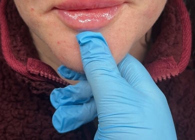 Close-up of lip enhancement procedure at Kr House Of Aesthetics, Dundee, Scotland, GB.
