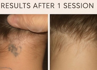 Tattoo removal results after one session at Lumina - Tattoo & Hair Removal, Bussum, Noord-holland, NL.