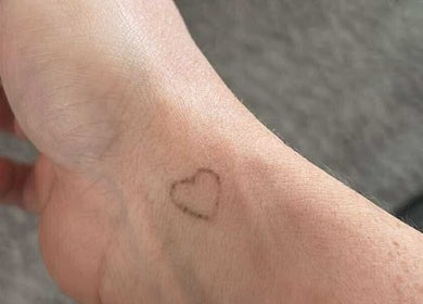 Small heart tattoo on wrist being removed at Lumina - Tattoo & Hair Removal, Bussum, Noord-holland, NL.
