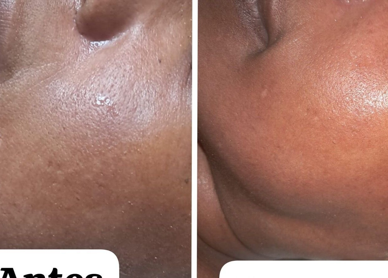 Antes y después de tratamiento facial en Luz Turquesa Aesthetics, Willemstad, Curaçao, CW.