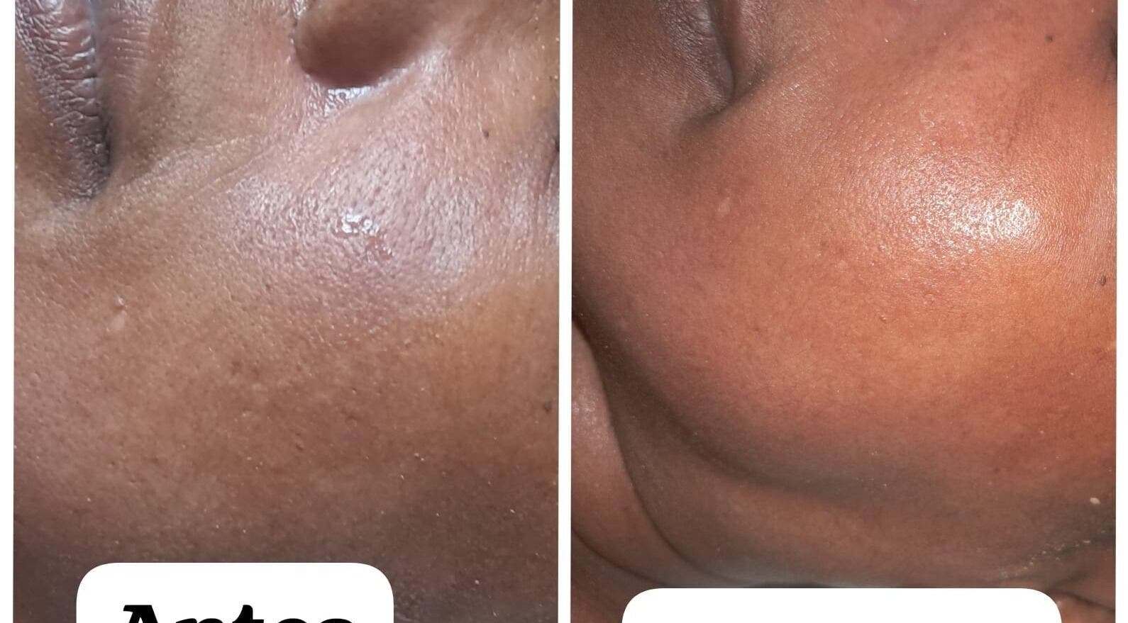 Antes y después de tratamiento facial en Luz Turquesa Aesthetics, Willemstad, Curaçao, CW.