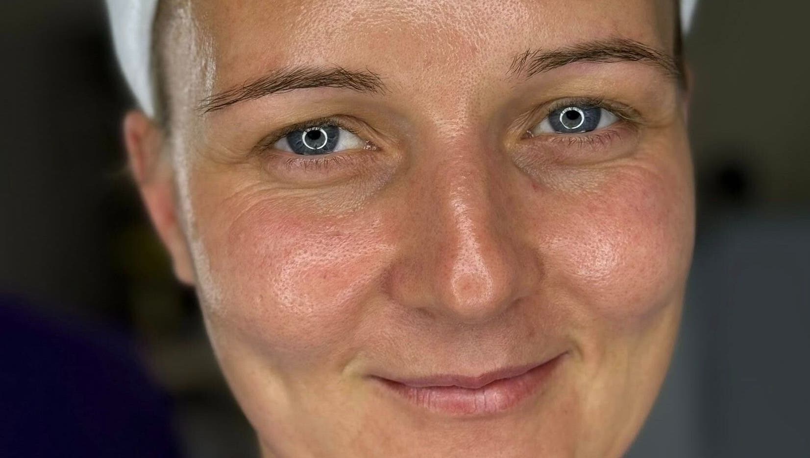 Close-up of clear skin at Vision Aesthetics and Skin, Chesterfield, England, GB.