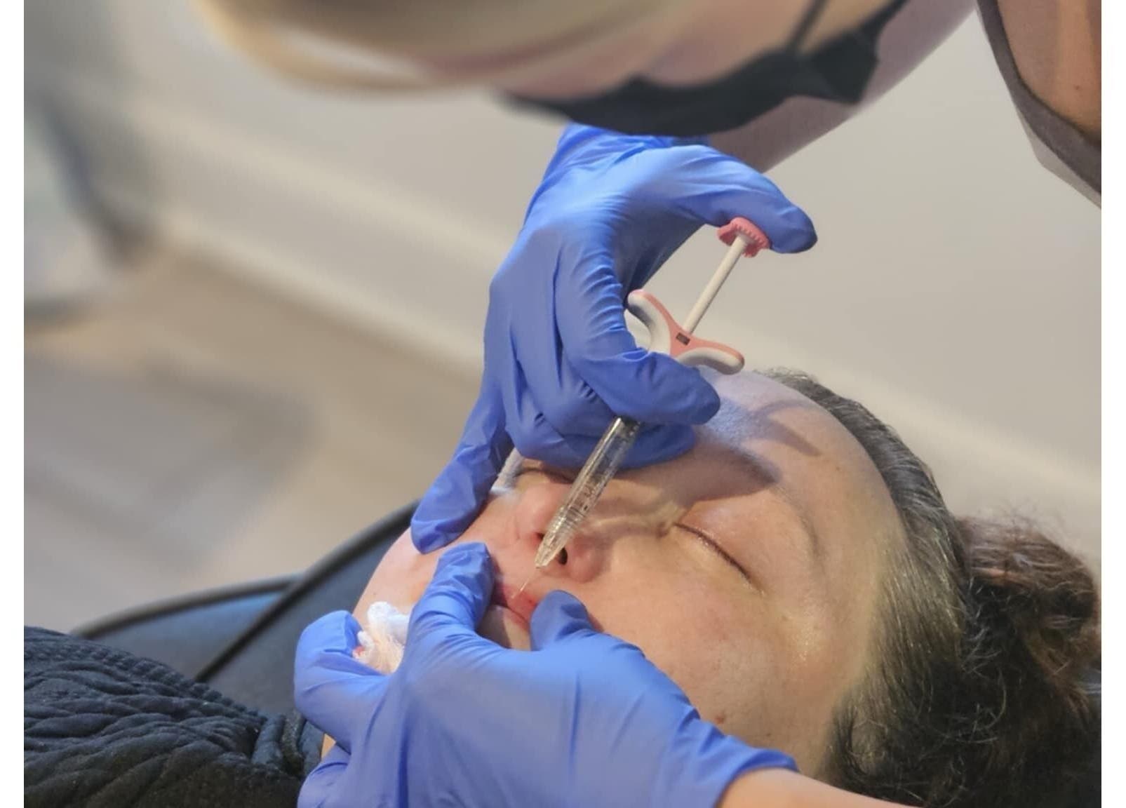 Beauty treatment at Vision Aesthetics and Skin in Chesterfield, England, GB showcasing dermal fillers.