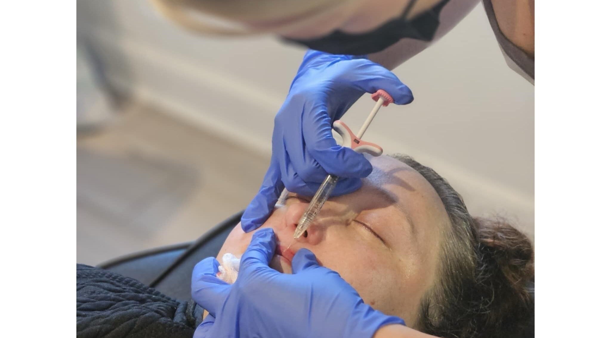 Beauty treatment at Vision Aesthetics and Skin in Chesterfield, England, GB showcasing dermal fillers.