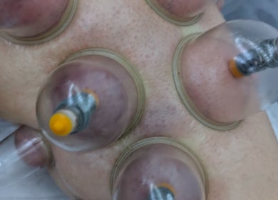 Cupping therapy session at Allison Grace Sports Massage in Oldham, England, GB.