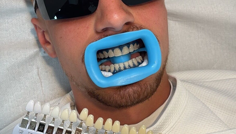 Teeth whitening session at Smile Studio By Savss, Watford, England, GB, showcasing shade guide and result.