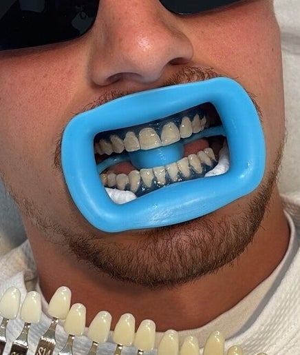 Teeth whitening session at Smile Studio By Savss, Watford, England, GB, showcasing shade guide and result.
