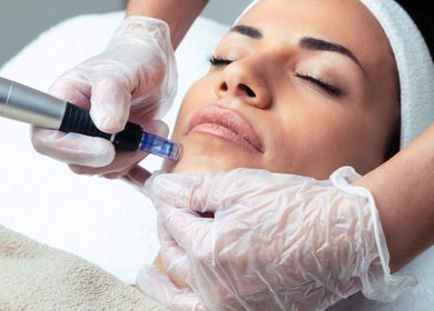 Facial treatment at LNLaesthetics, Addlestone, England, GB showcasing microneedling for skin rejuvenation.