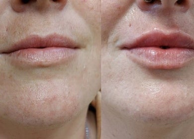 Before and after lip enhancement at Safe Hands Aesthetics ltd, Aberkenfig, Wales, GB.