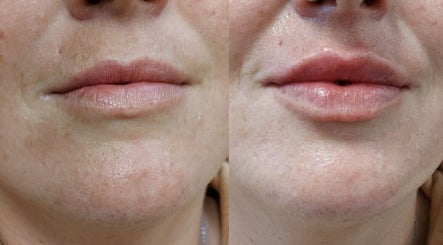 Before and after lip enhancement at Safe Hands Aesthetics ltd, Aberkenfig, Wales, GB.