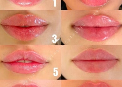 Lip enhancement results at Nins Beauty & Aesthetics, Shipley, England, GB showcasing glossy, fuller lips.
