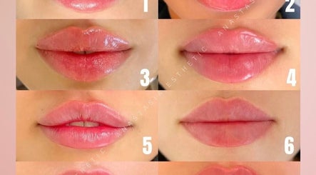 Lip enhancement results at Nins Beauty & Aesthetics, Shipley, England, GB showcasing glossy, fuller lips.