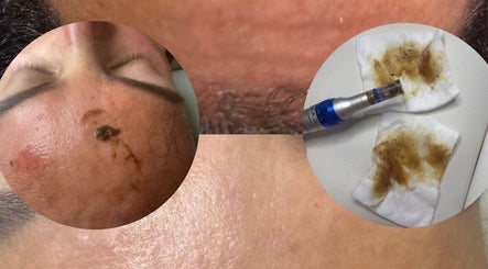 Close-up of a skin treatment at Tulay, Nantes, Pays De La Loire, FR showcasing before and after results.