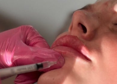 Lip enhancement procedure at You’re Lit Clinic in Snodland, England, GB. Pink-gloved practitioner in action.