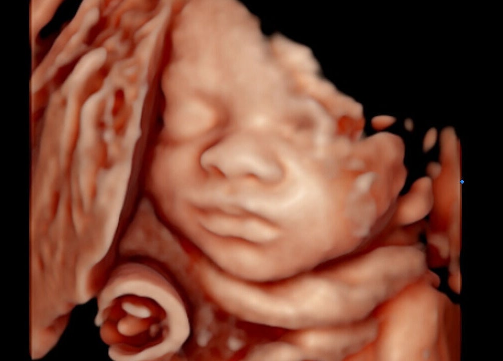 3D ultrasound showing baby at Sunbeam Sonogram, De Pere, Wisconsin, US, highlighting prenatal imaging services.