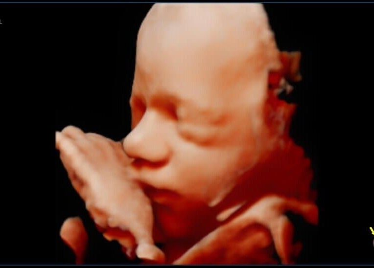 3D sonogram of a baby at Sunbeam Sonogram, De Pere, Wisconsin, US, showcasing detailed facial features.