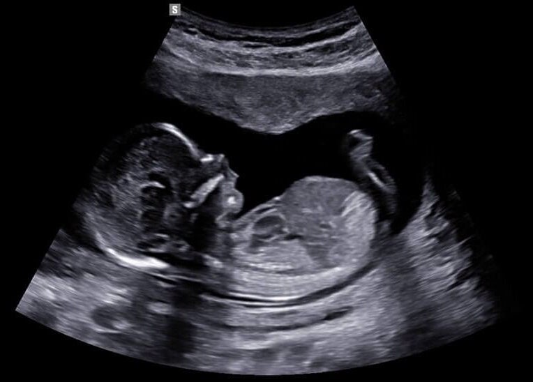 Ultrasound image at Sunbeam Sonogram in De Pere, Wisconsin, US, showing a detailed view of a developing fetus.