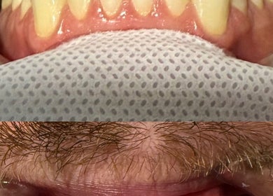 Close-up of a dental procedure at The Whitening Room, Happy Valley, South Australia, AU showcasing bright teeth.