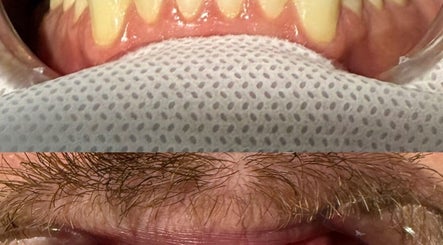 Close-up of a dental procedure at The Whitening Room, Happy Valley, South Australia, AU showcasing bright teeth.