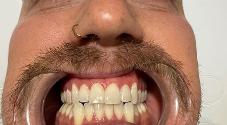 Close-up of a smiling face with dental equipment at The Whitening Room, Happy Valley, South Australia, AU.