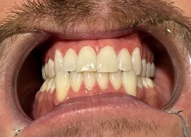 Close-up of dental whitening at The Whitening Room, Happy Valley, South Australia, AU.