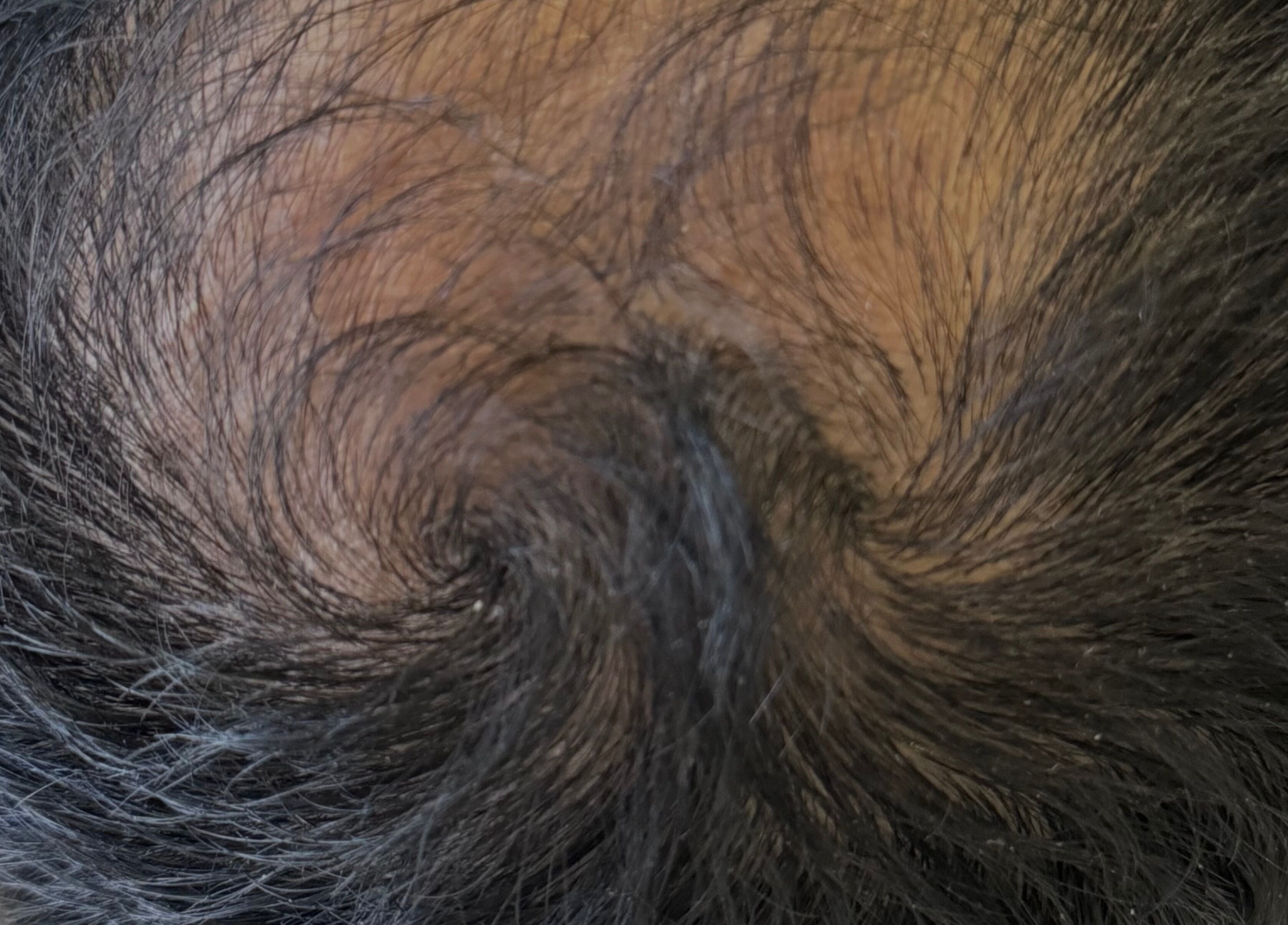 Close-up of a human scalp at Re.scalp, Birmingham, England, GB showcasing hair pattern details.