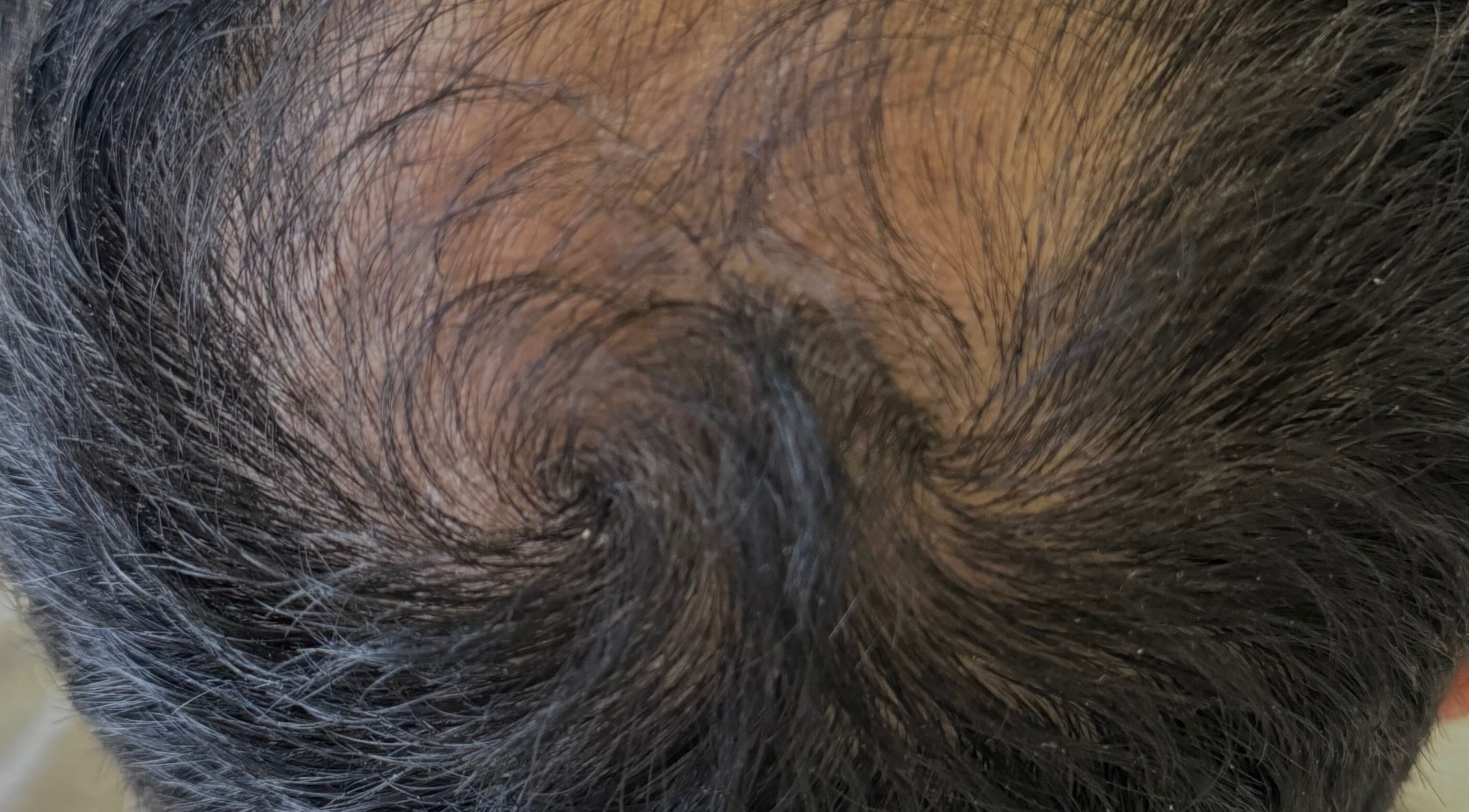 Close-up of a human scalp at Re.scalp, Birmingham, England, GB showcasing hair pattern details.
