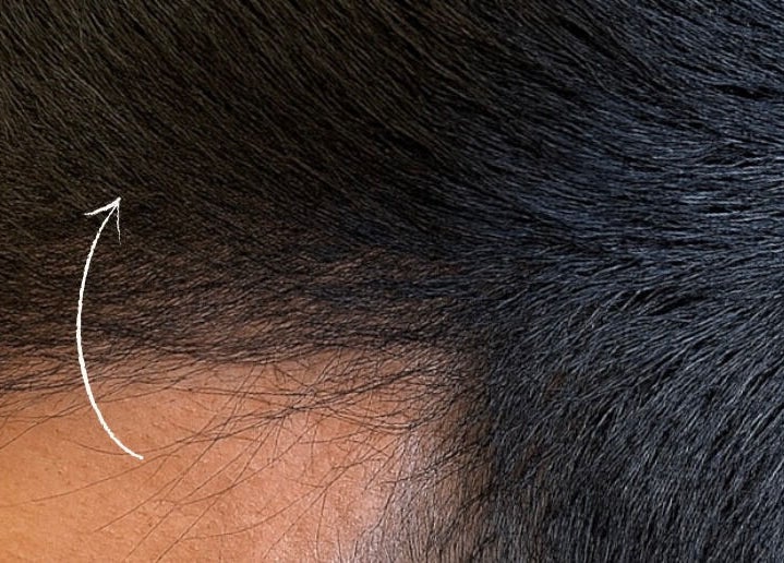 Close-up of a perfectly treated hairline at Re.scalp, Birmingham, England, GB, showcasing advanced hair care.