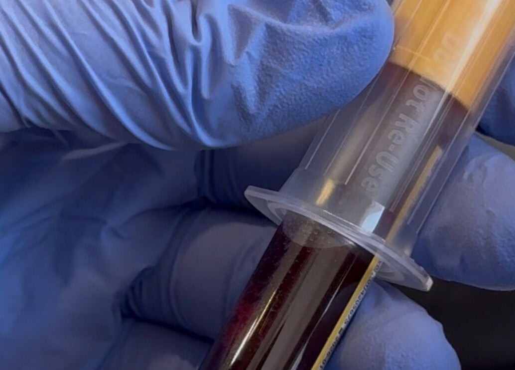 Professional PRP treatment at Re.scalp, Birmingham, England, GB enhances scalp health and rejuvenation.