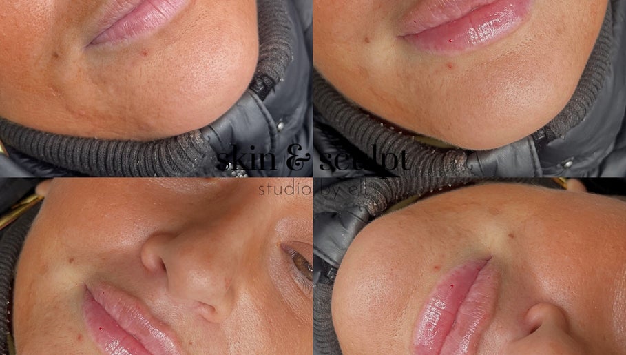 Closeup of rejuvenated skin at Skin and Sculpt Studio by Ell, Poulton-le-Fylde, England, GB.