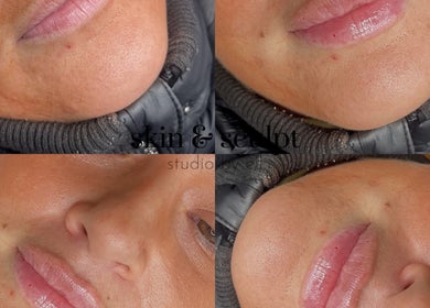 Closeup of rejuvenated skin at Skin and Sculpt Studio by Ell, Poulton-le-Fylde, England, GB.
