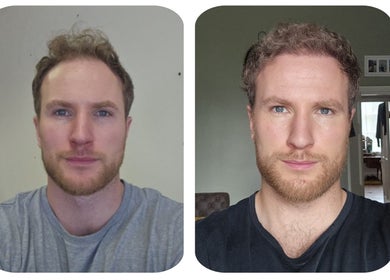 Before and after images of a man's face at Clinic Center London, London, England, GB.