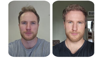 Before and after images of a man's face at Clinic Center London, London, England, GB.