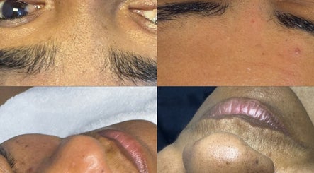 Tratamento facial em Samy Nunes, Cascais, Lisboa, PT, destacando a pele suavizada e saudável.