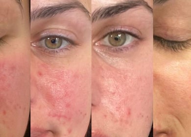 Before and after skin transformation at Signature Skin, Little Massingham, England, GB showcases facial improvements.