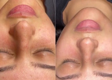 Before and after facial treatment at LUXE skincare in Melbourne, Victoria, AU, showcasing clear, glowing skin.