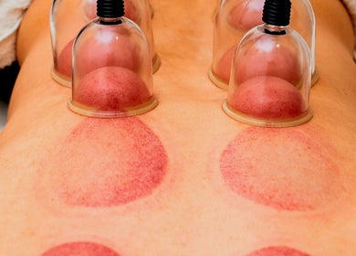 Cupping therapy session at Joro Studio, Melbourne, Victoria, AU providing relaxation and healing.