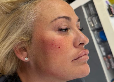 Close-up of a client during dermal treatment at KINGS AESTHETICS TRAINING ACADEMY, Ashton-in-makerfield, England, GB.