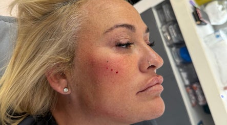 Close-up of a client during dermal treatment at KINGS AESTHETICS TRAINING ACADEMY, Ashton-in-makerfield, England, GB.