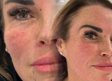 Close-up of a woman's rejuvenated skin at KINGS AESTHETICS TRAINING ACADEMY, Ashton-in-makerfield, England, GB.