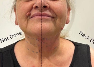 Before and after neck treatment at KINGS AESTHETICS TRAINING ACADEMY, Ashton-in-makerfield, England, GB.