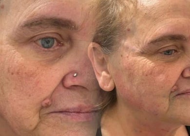 Facial transformation at KINGS AESTHETICS TRAINING ACADEMY in Ashton-in-makerfield, England, GB.
