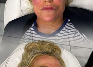 Facial treatment at KINGS AESTHETICS TRAINING ACADEMY, Ashton-in-makerfield, England, enhancing skin vitality.