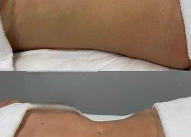 Body contouring results at Sculptmebyjord, Loughton, England, GB. Effective wellness transformation.