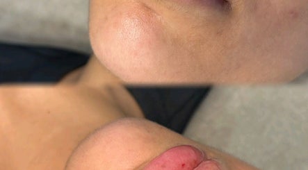 Chin enhancement results at Aesthetics By Kiki in Leeds, England, GB showcasing skin improvement.